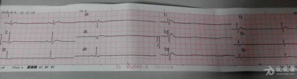 肺癌的病人 临终心电图