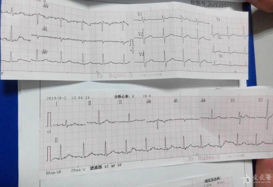临终病人的心电图样子图片