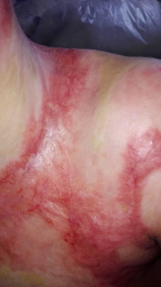 酒精壶mod烧伤2月图片