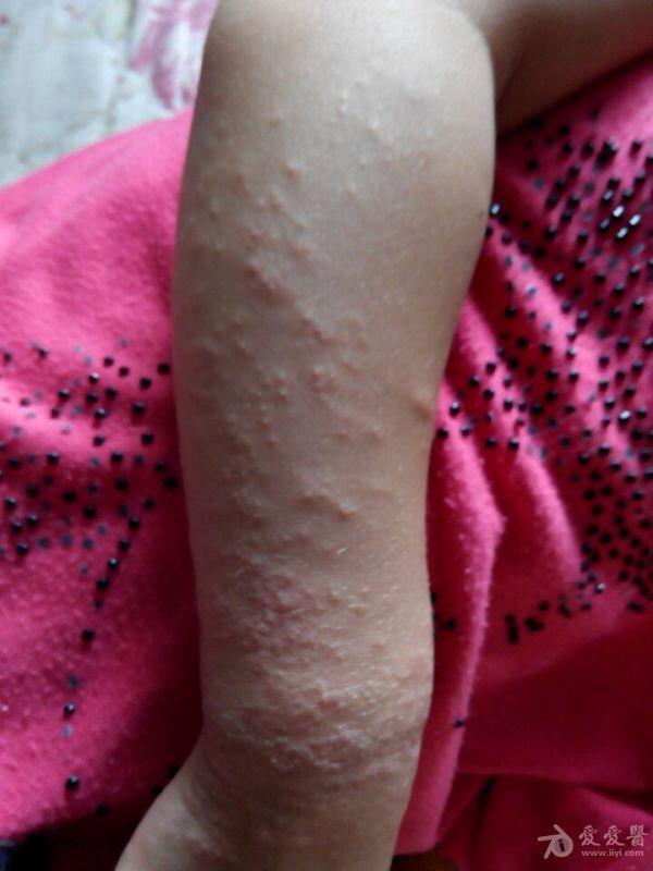 是湿疹还是接触性皮炎??? - 中医皮肤版 - 爱爱医医学论坛