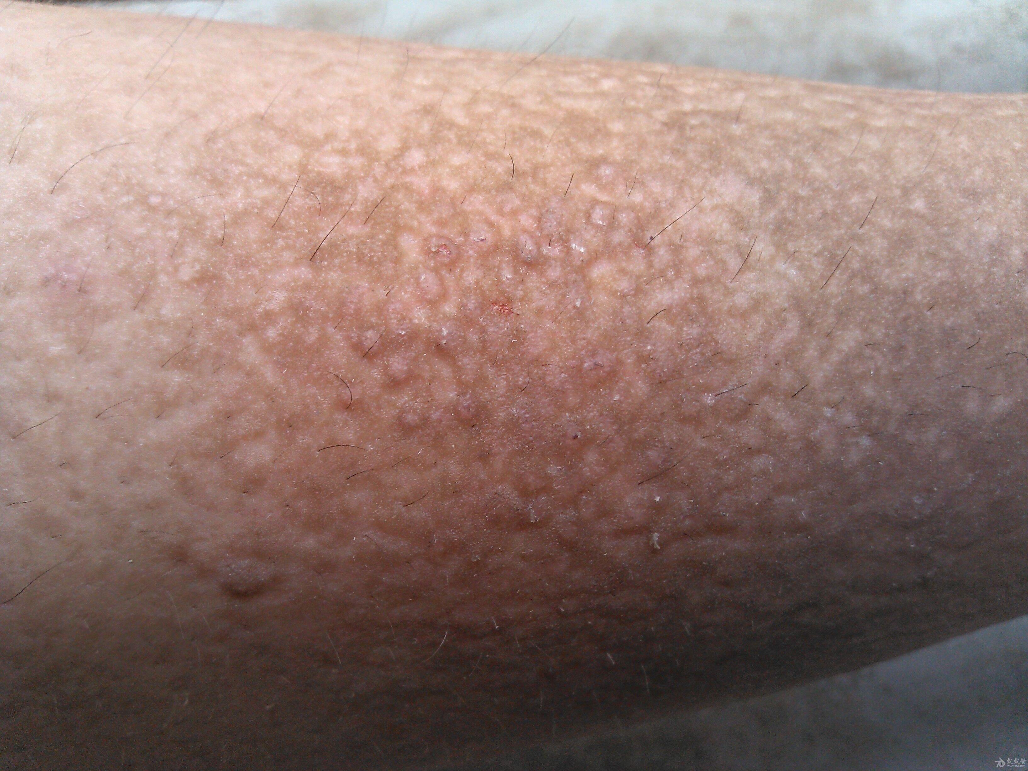 小腿皮肤瘙痒症图片图片