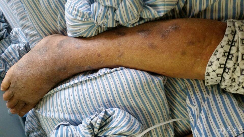 许多医师没见过的全身黑色结节请大家给出诊疗意见