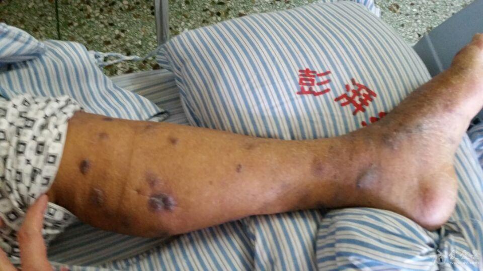 许多医师没见过的全身黑色结节请大家给出诊疗意见