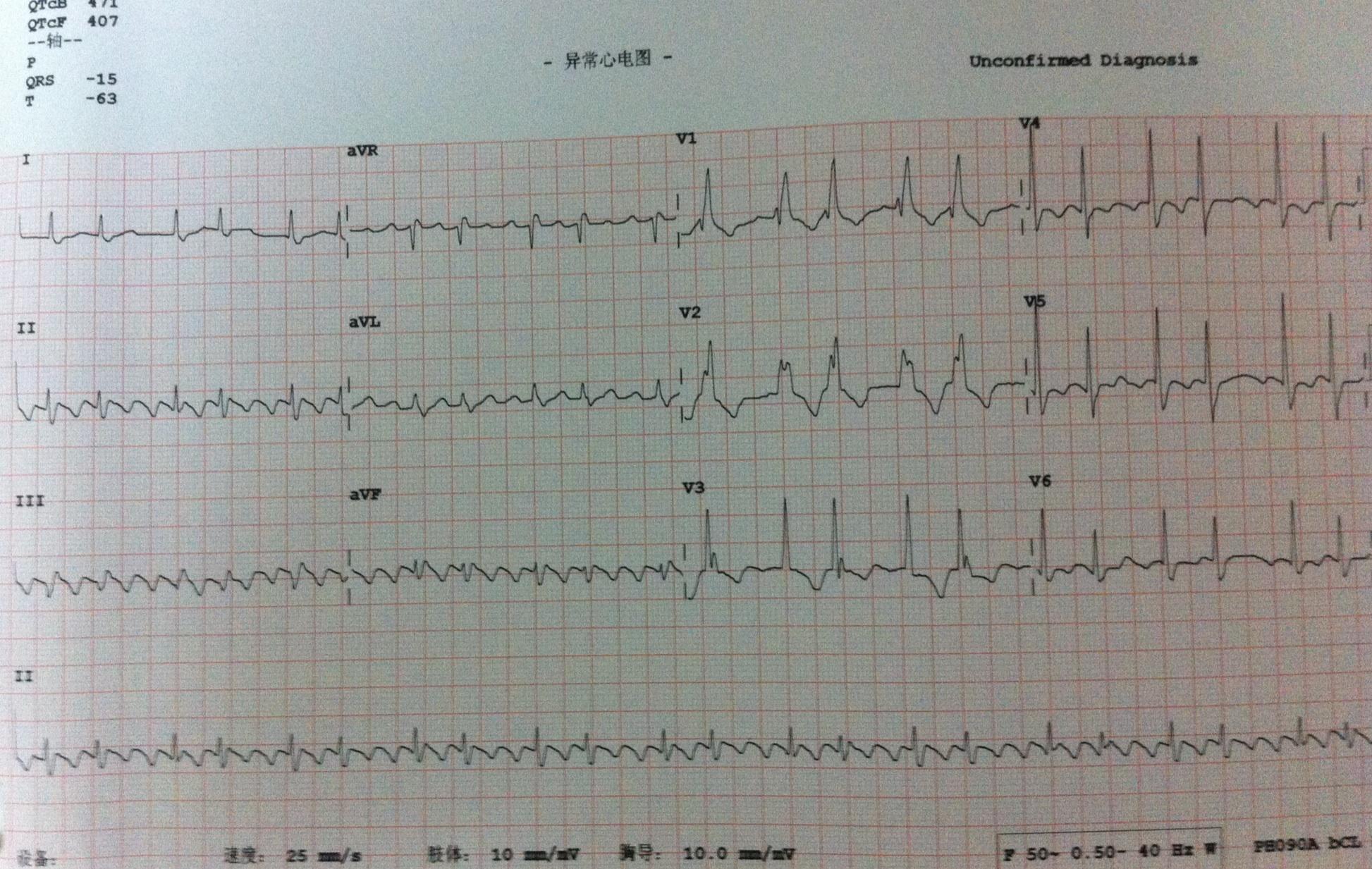 [心电图分析] 心房扑动?