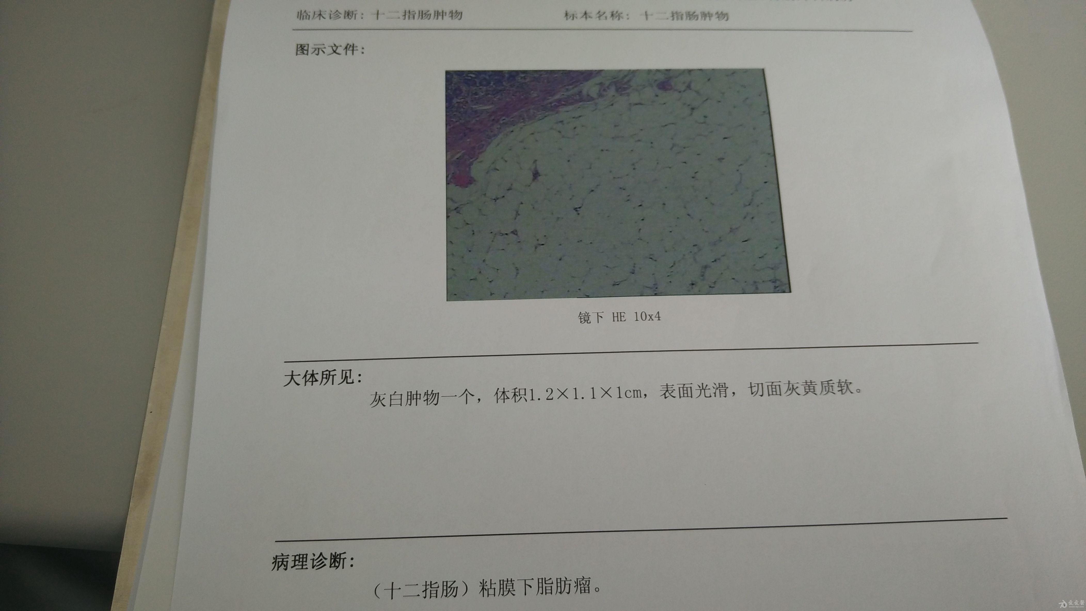 十二指肠肿物一例病理提示脂肪瘤