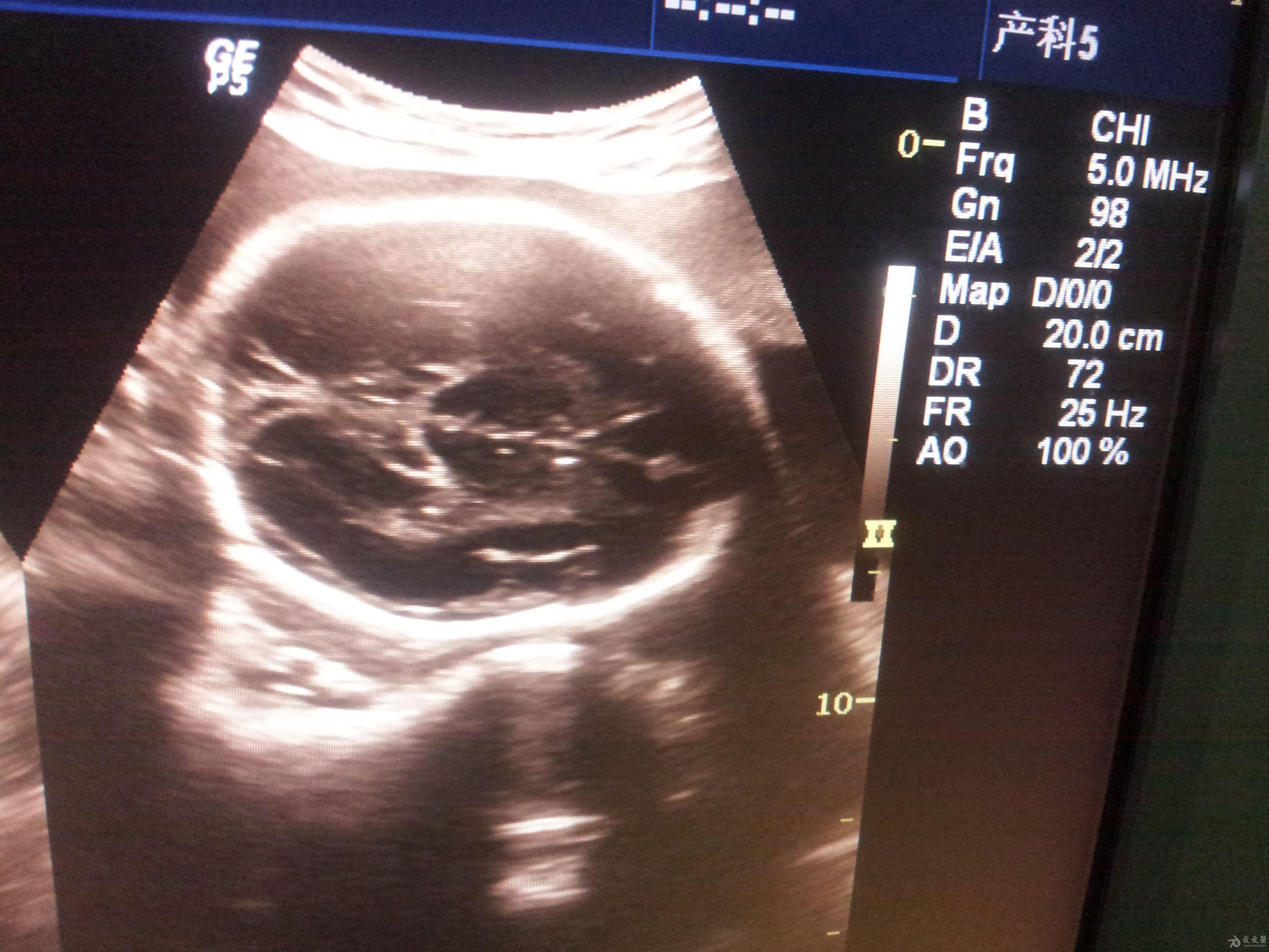 胎儿双顶径图片图片