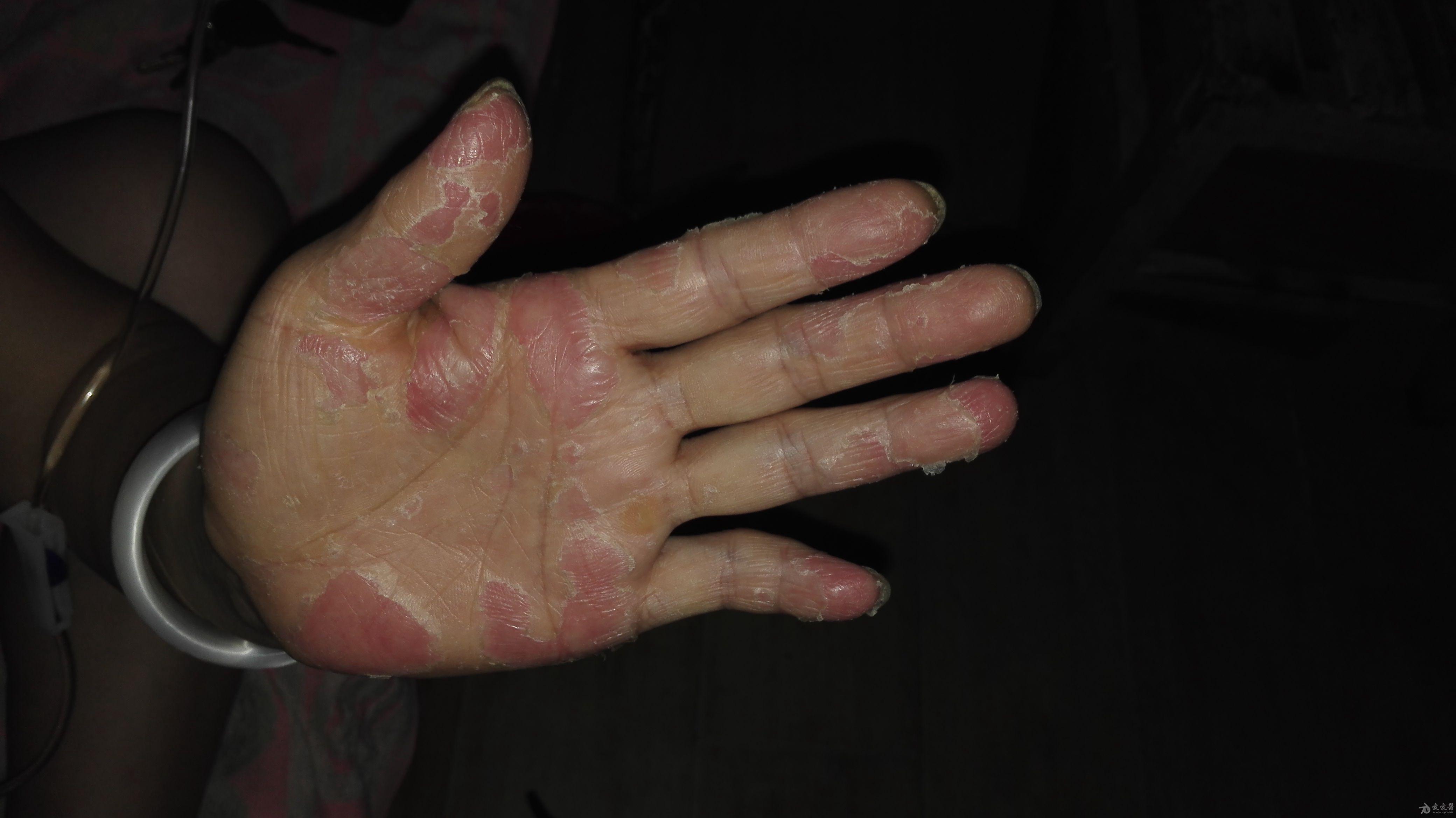 专家请看看是什么皮肤病,反复发作性瘙痒蜕皮一年