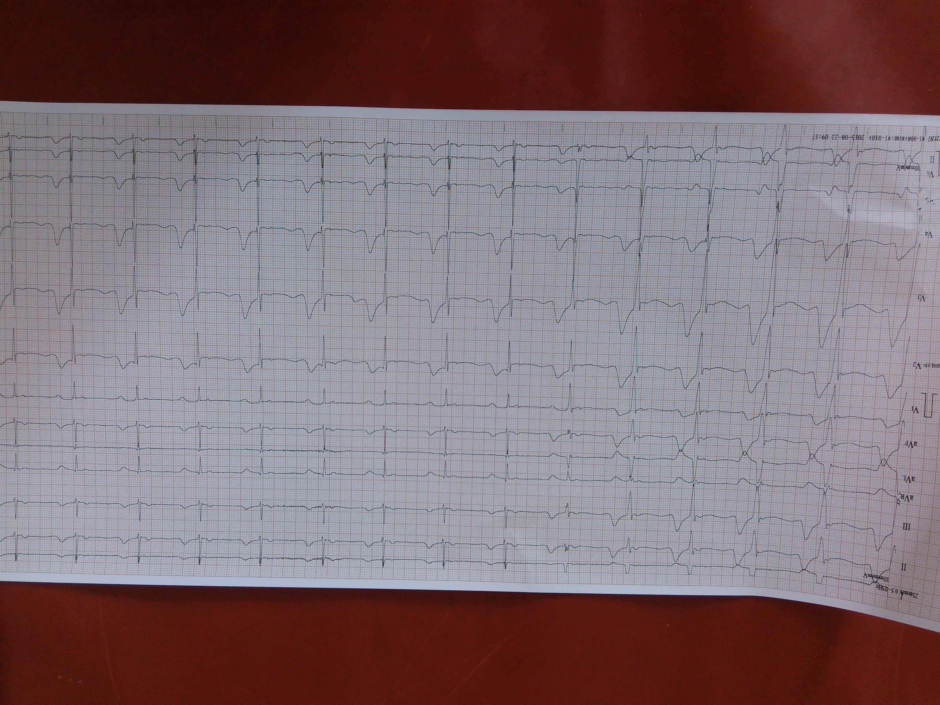 心电图脑电图专业讨论版 - 爱爱医医学论坛