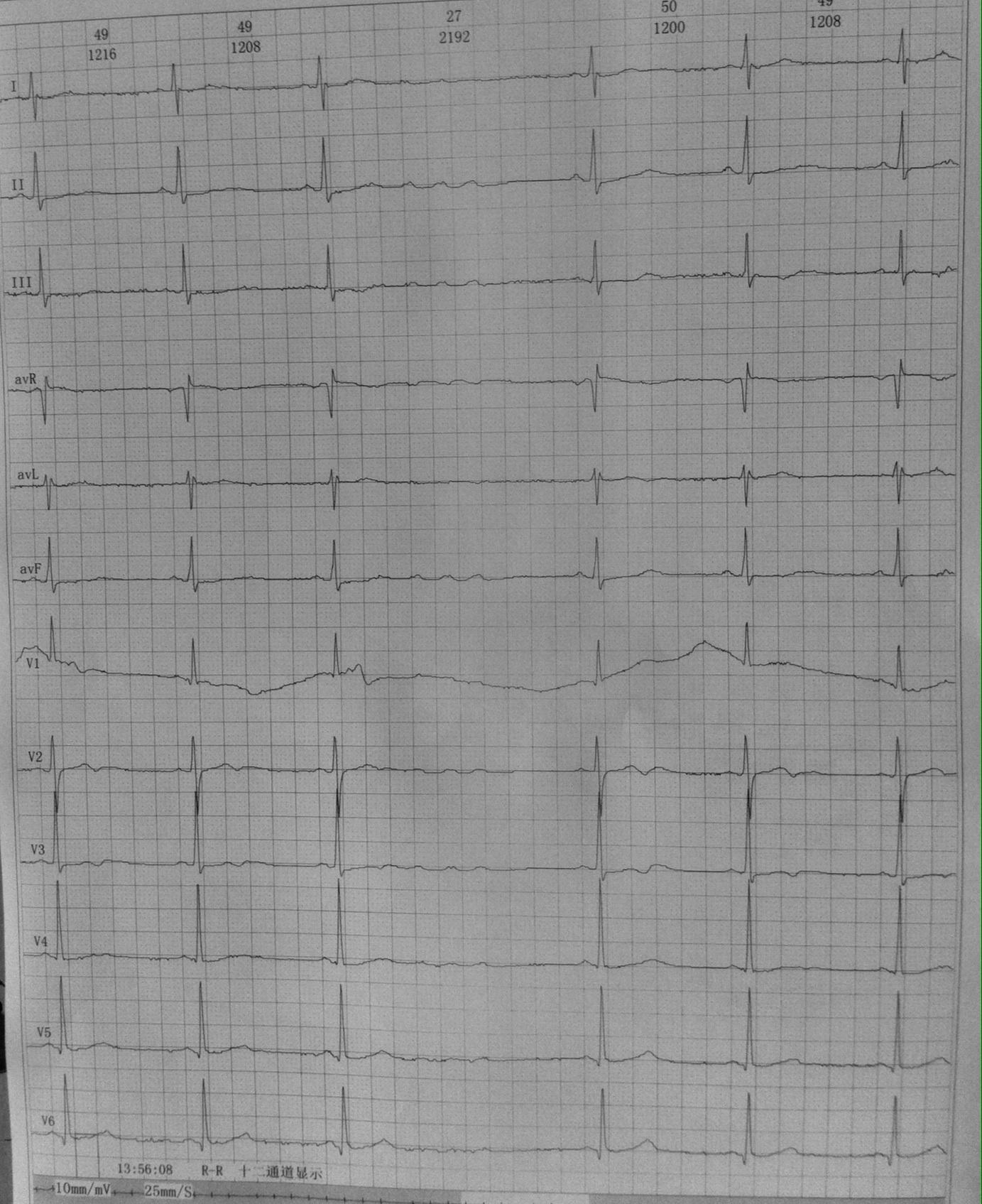 长rr间期 - 心电图脑电图专业讨论版 - 爱爱医医学论坛