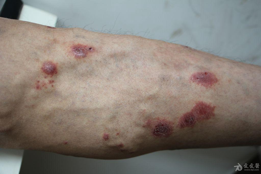 常见病淤滞性皮炎