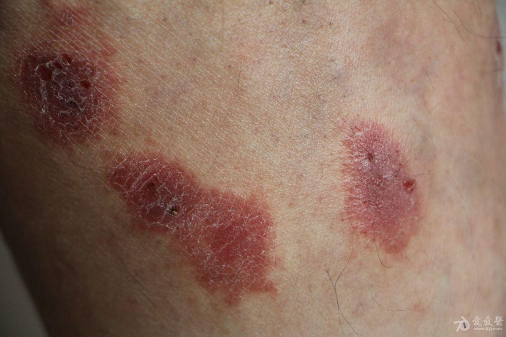 常见病淤滞性皮炎