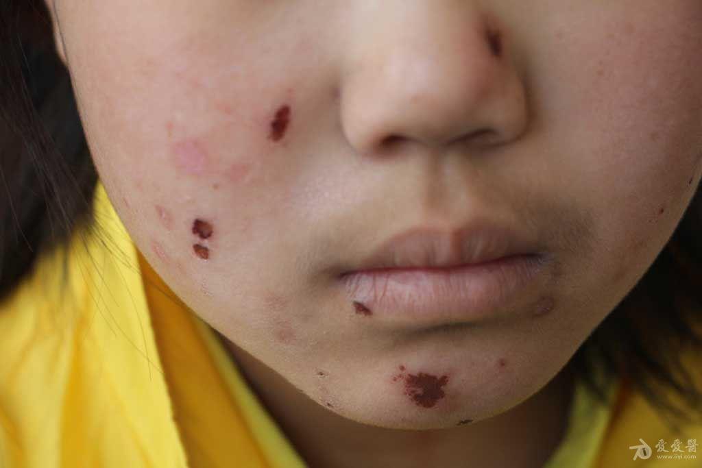 2015年皮肤版有奖病例猜答38答案人工皮炎