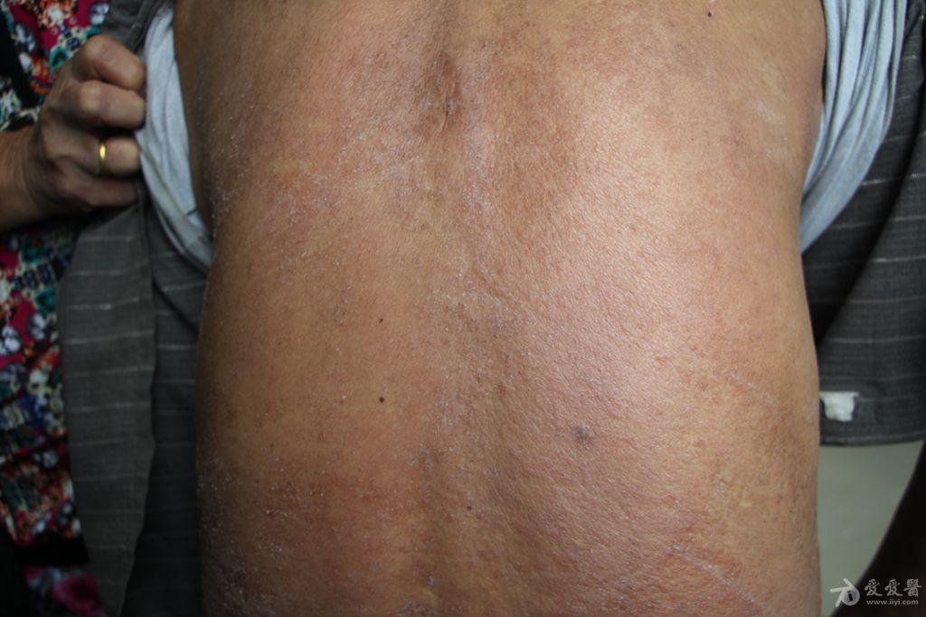 面部躯干四肢出现红斑,苔癣样丘疹,鳞屑,如何治疗?