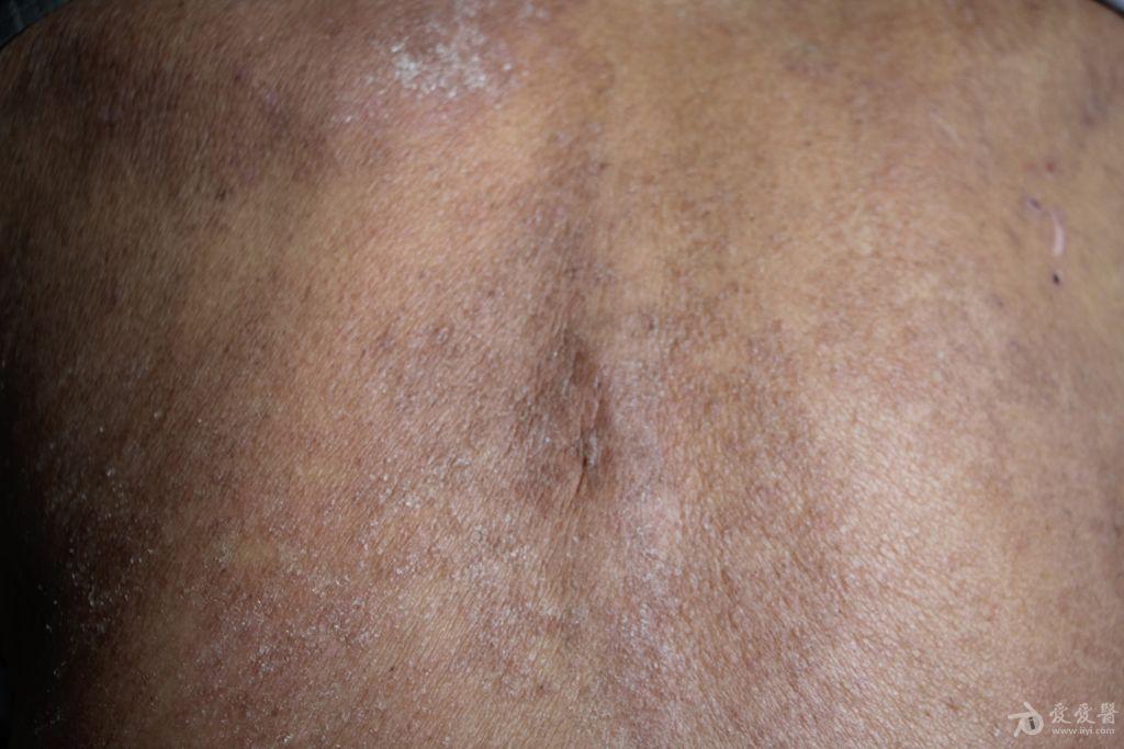 面部躯干四肢出现红斑,苔癣样丘疹,鳞屑,如何治疗?