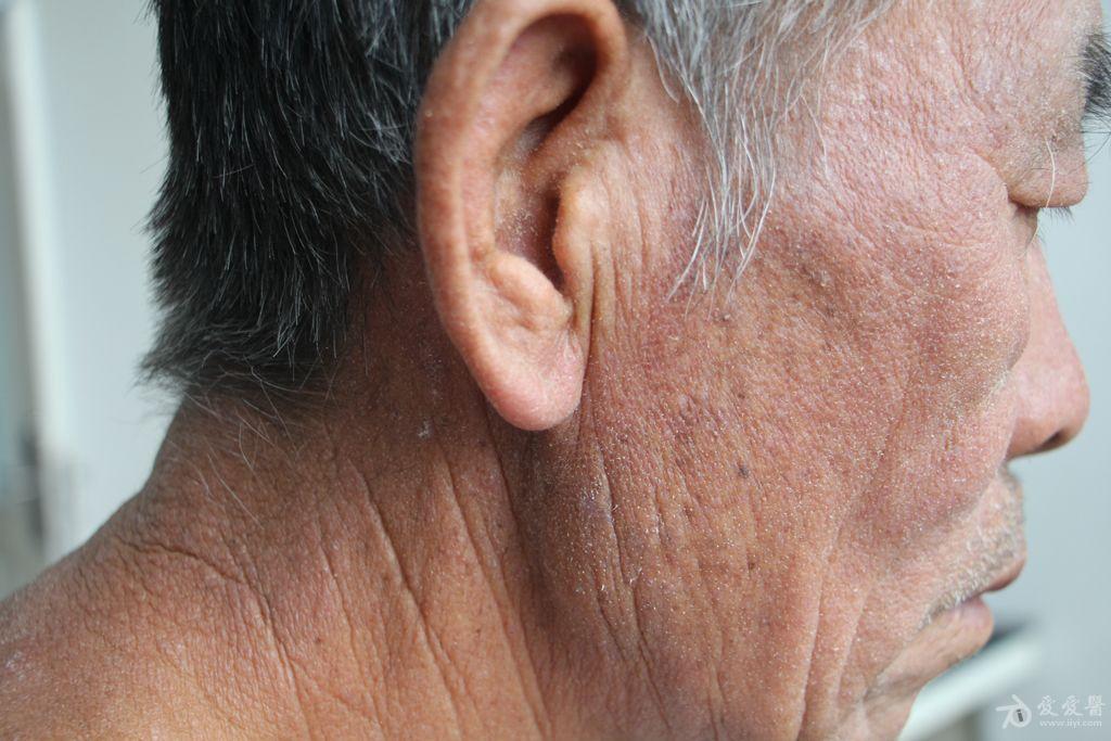 面部躯干四肢出现红斑,苔癣样丘疹,鳞屑,如何治疗?