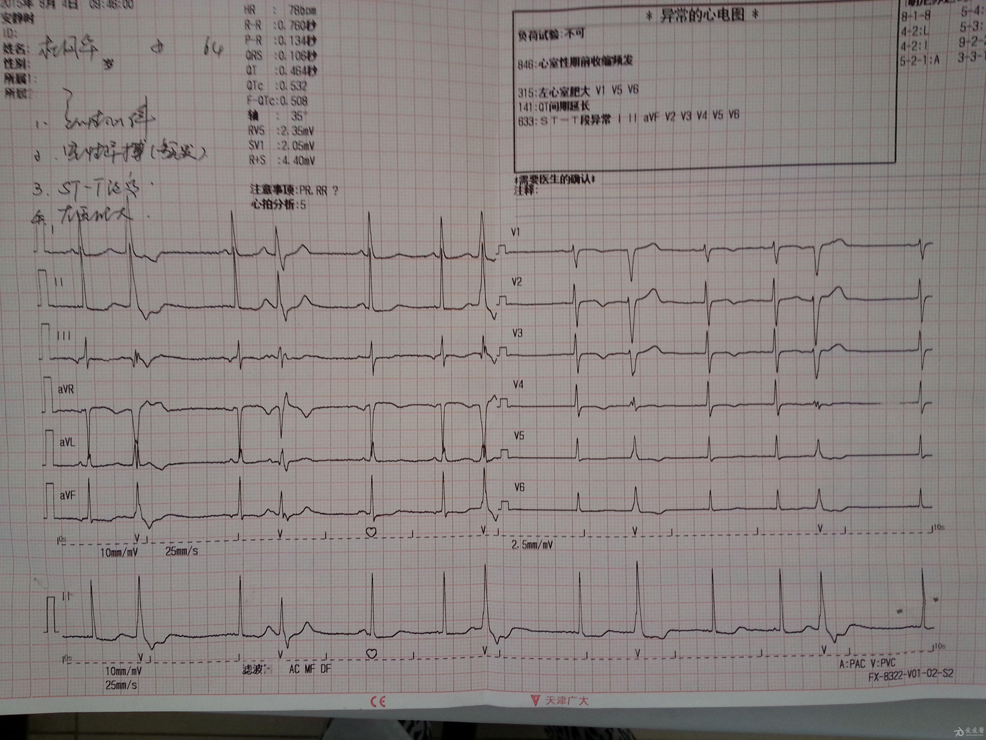 大家幫忙看看心電圖