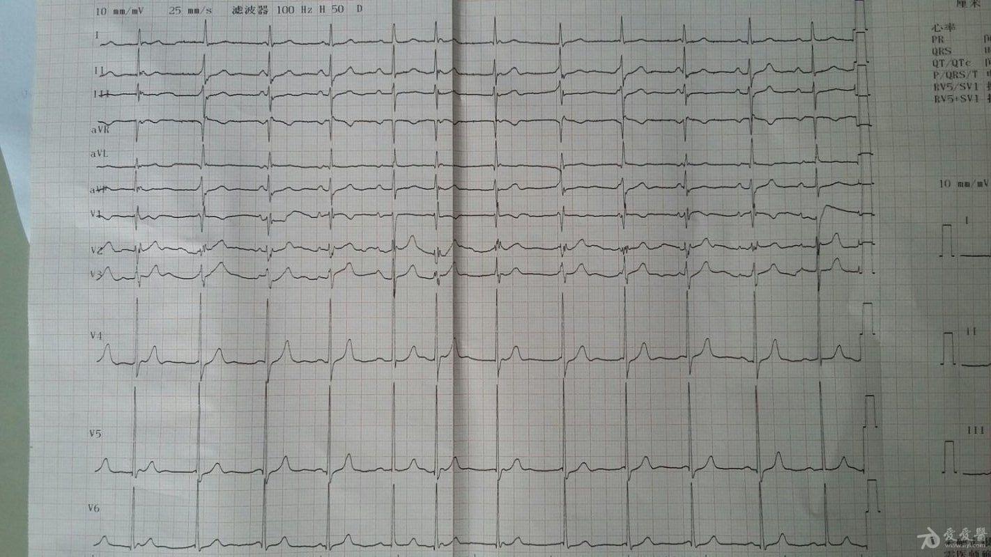 房室分离心电图图片