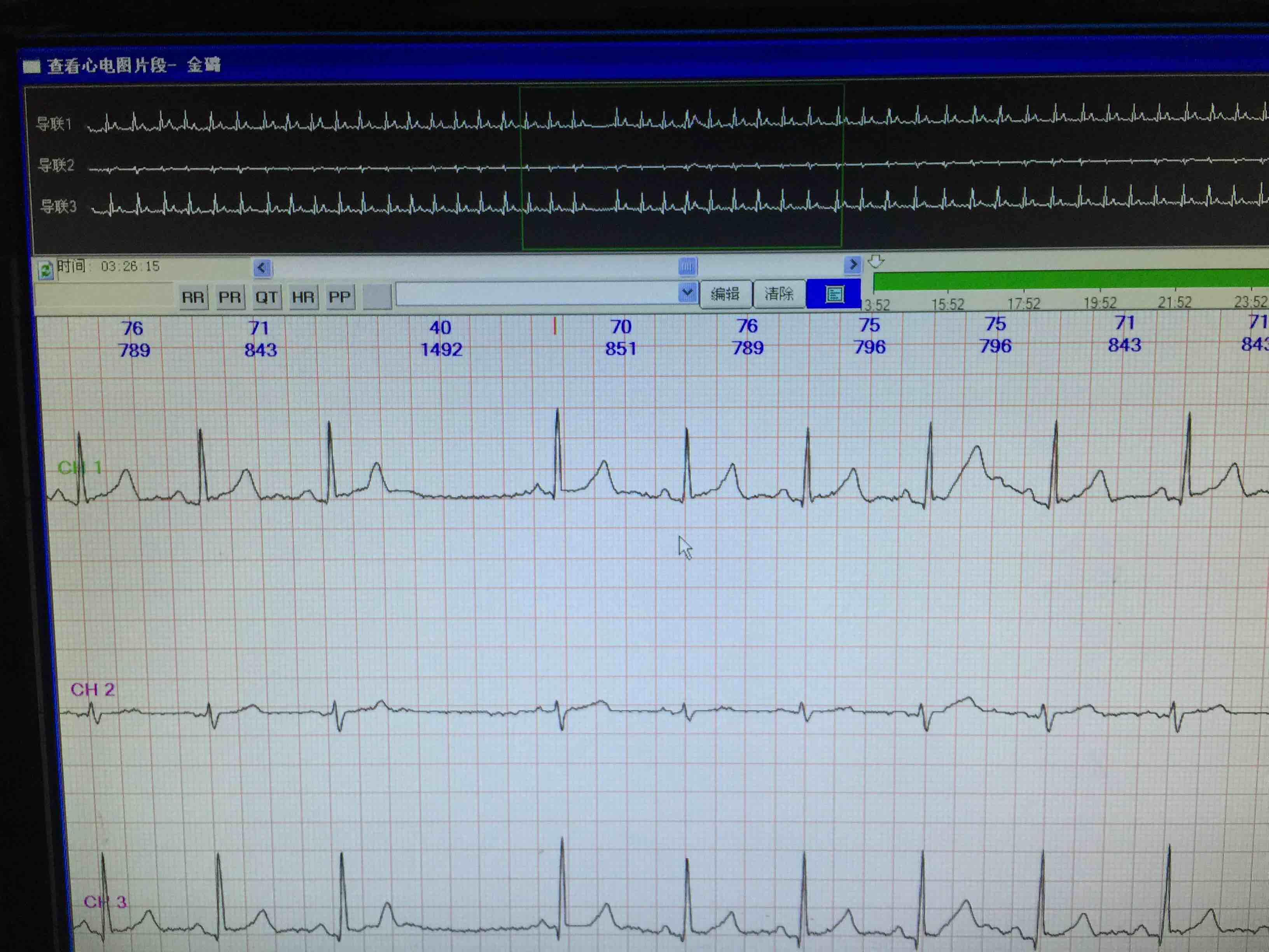 房早未下传心电图图片图片