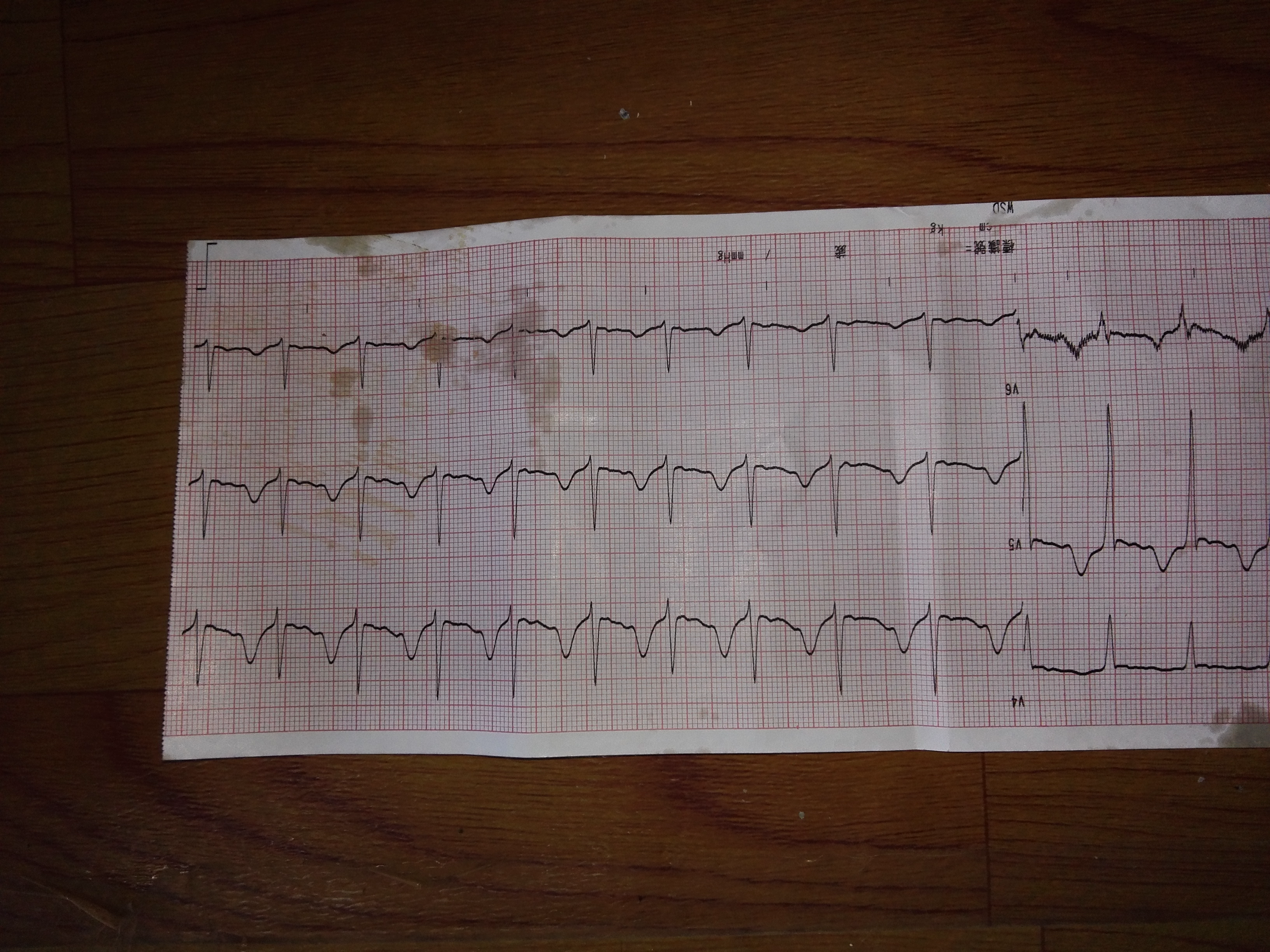 帮忙看下心电图