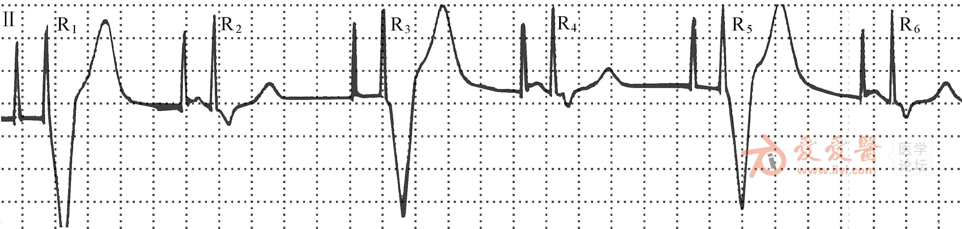 基础起搏心电图解读系列讲座十一起搏器起搏功能异常的心电图表现