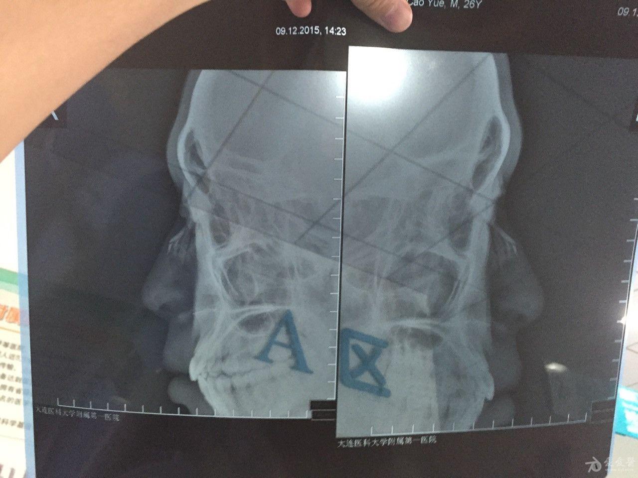 鼻骨骨折ct和dr 耳鼻咽喉 头颈外科专业版 爱爱医医学论坛