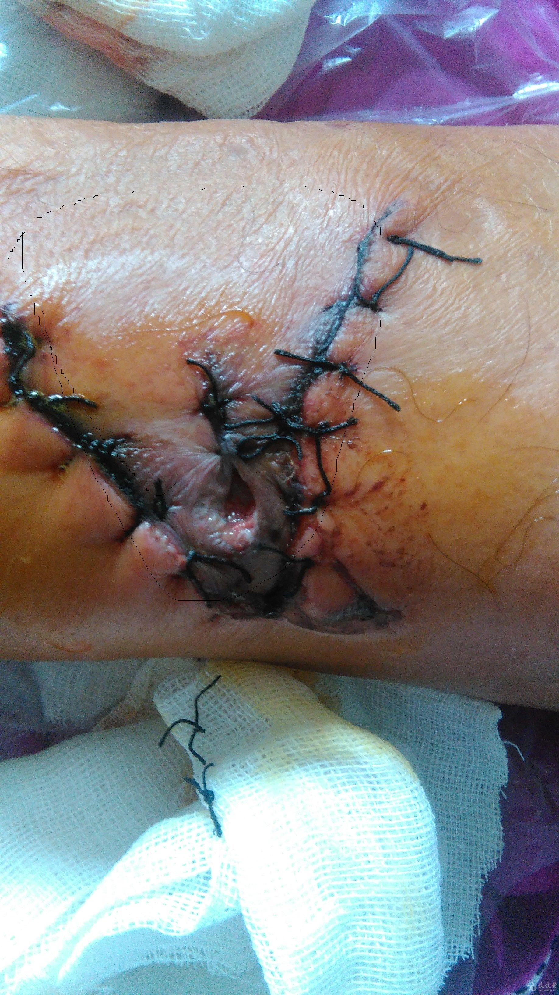 外伤后小腿内侧皮肤撕脱伴挤压伤