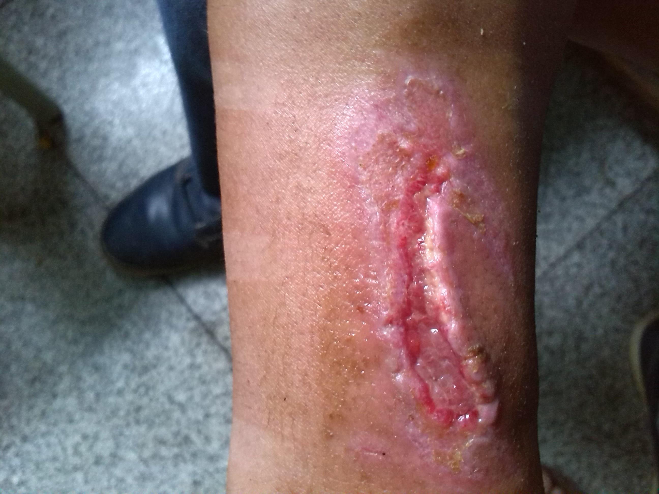 外伤后小腿内侧皮肤撕脱伴挤压伤