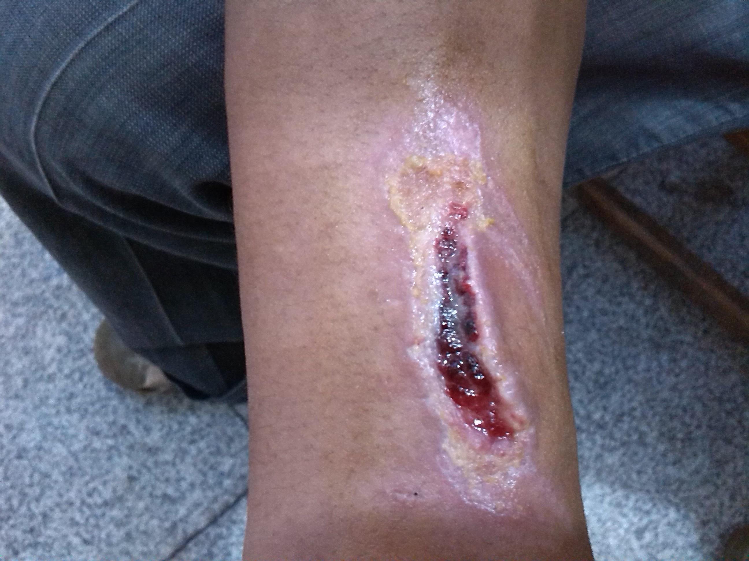 外伤后小腿内侧皮肤撕脱伴挤压伤