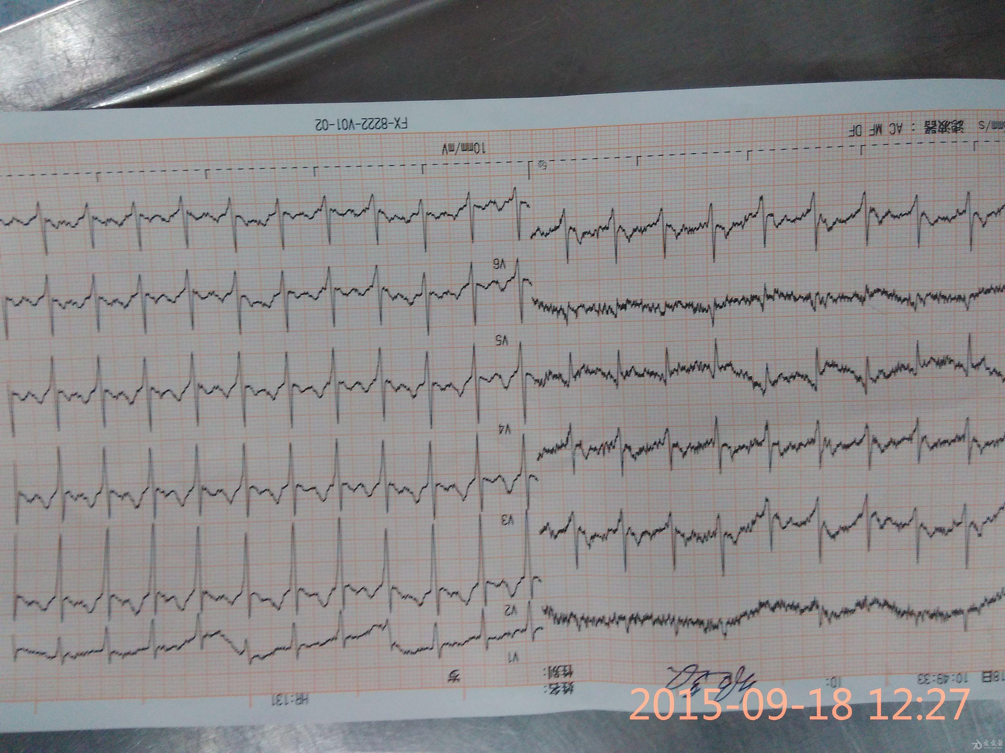 看看这个室上速的病人窦速房速折返