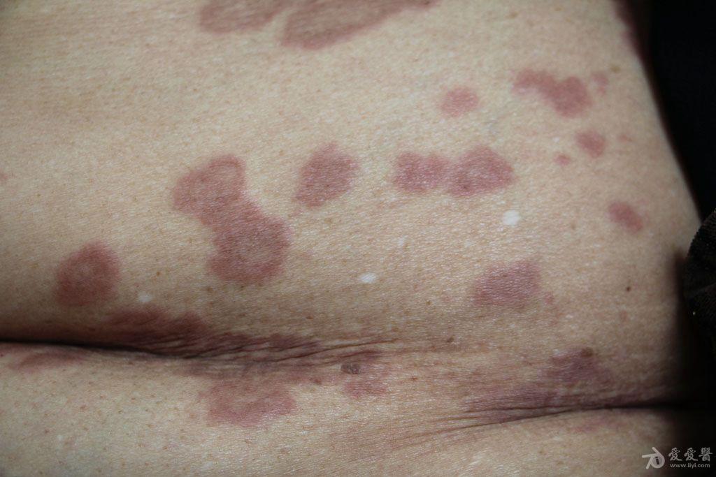 2015年皮肤版有奖病例猜答42病理结果环状肉芽肿