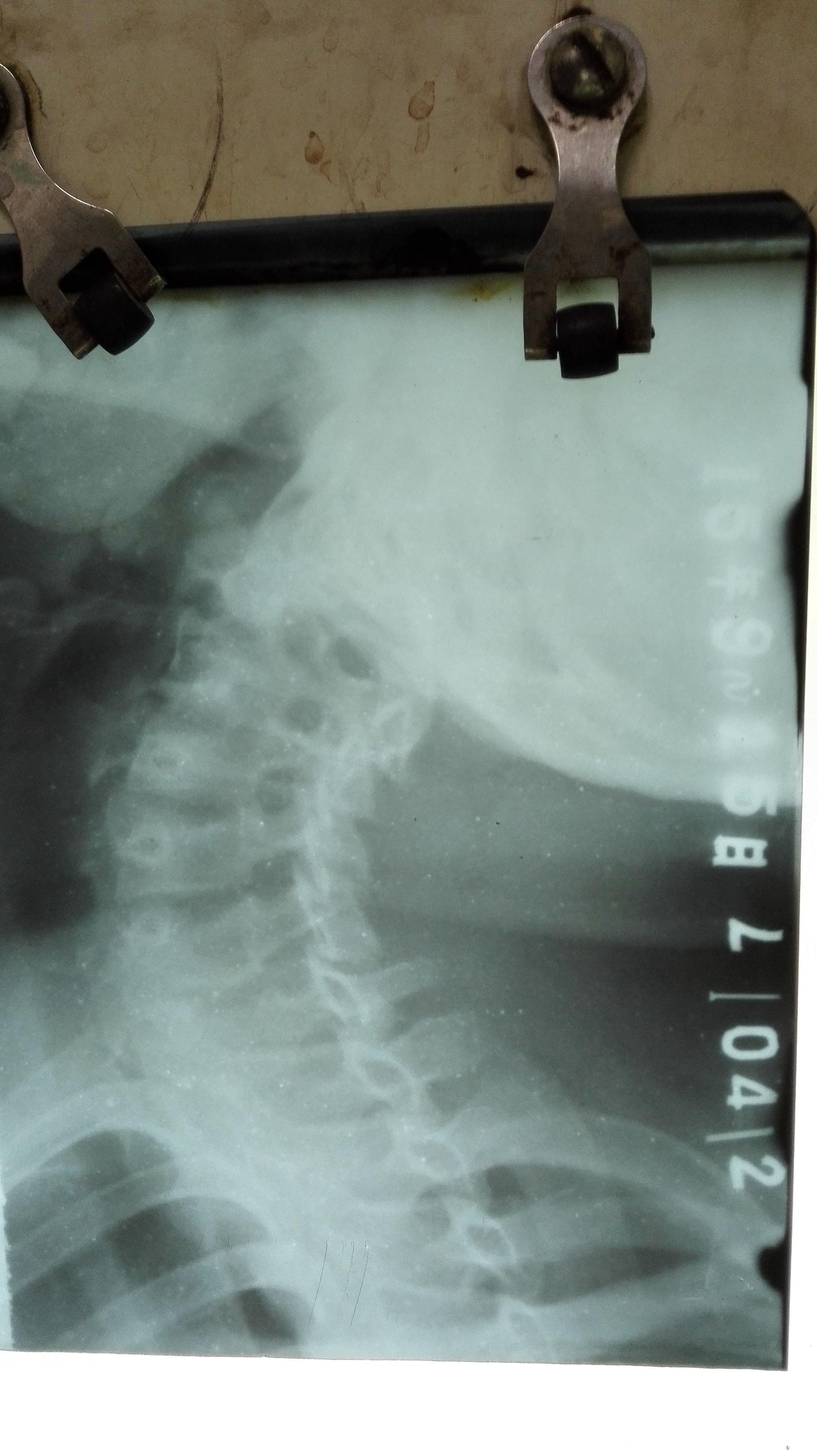 颈椎斜位x线摄影图片