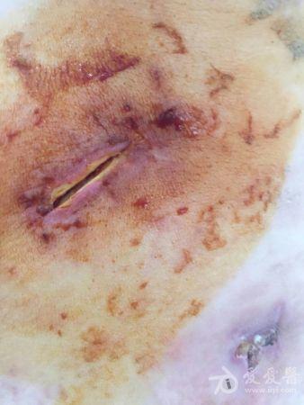 结核瘤术后伴糖尿病史,伤口如何处理?