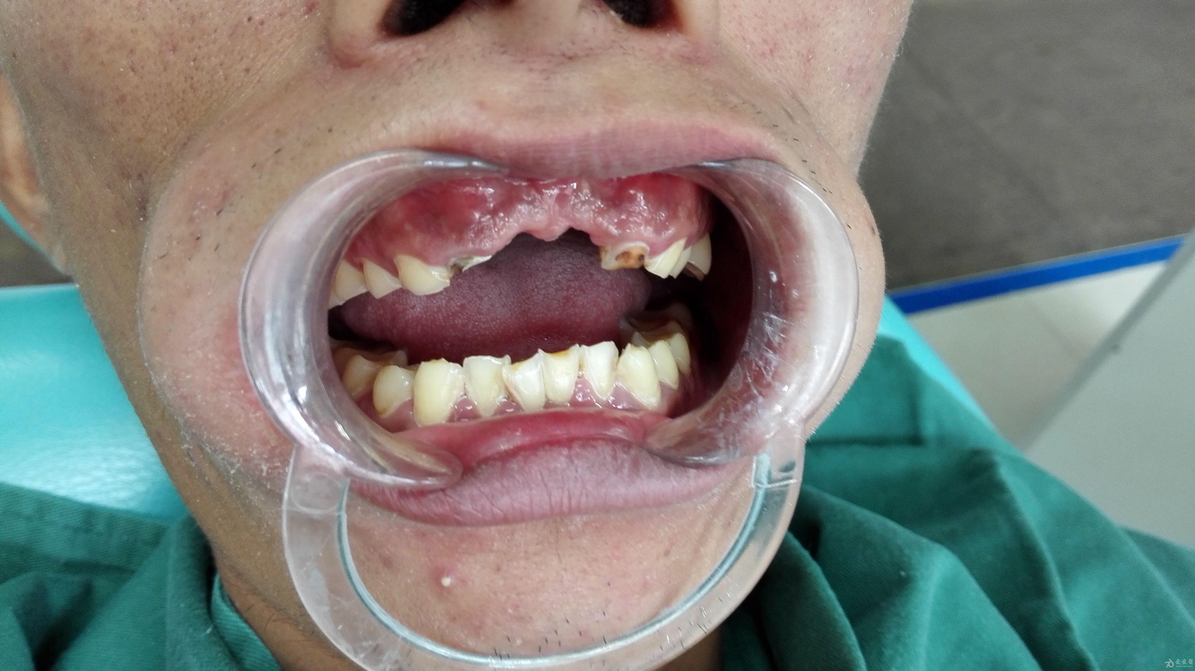 超小合,咬合紧的前牙修复