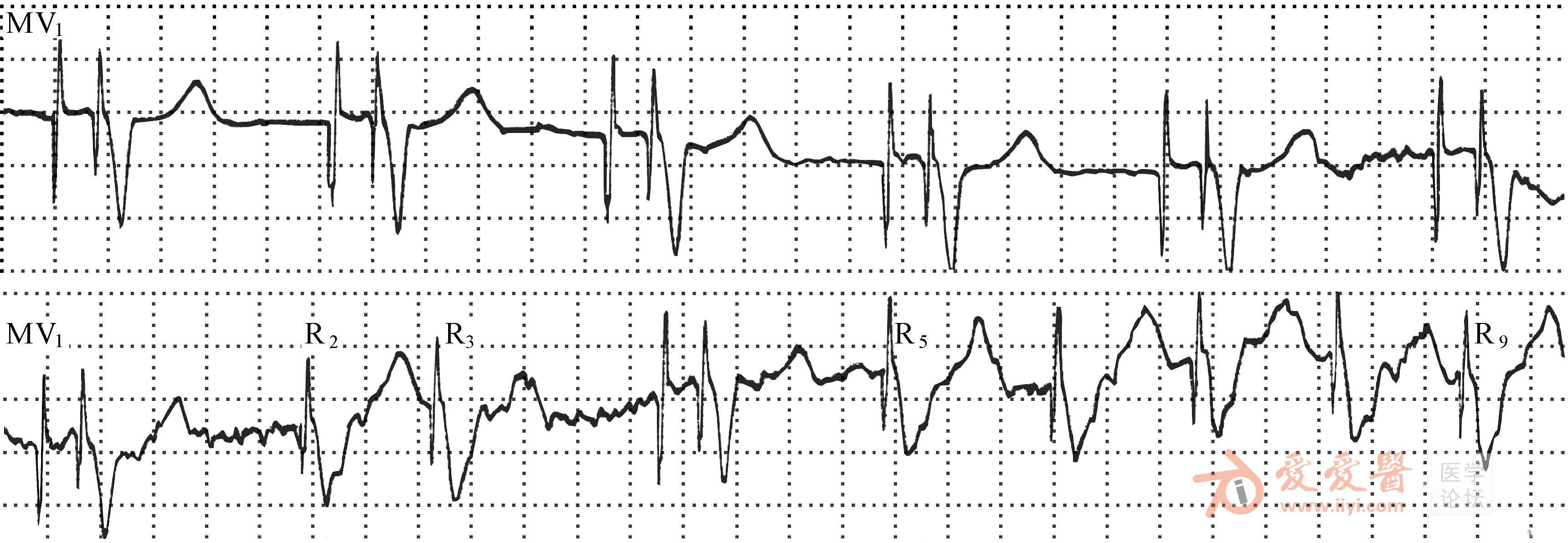 双腔起搏器心电图图片