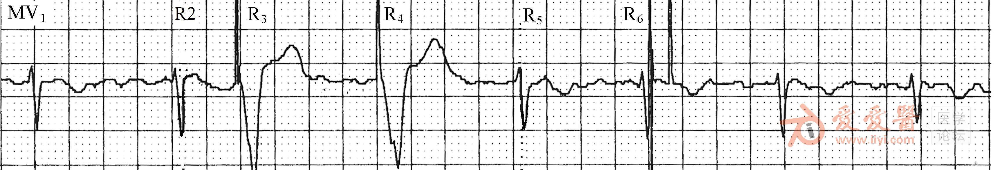 双腔起搏器心电图图片