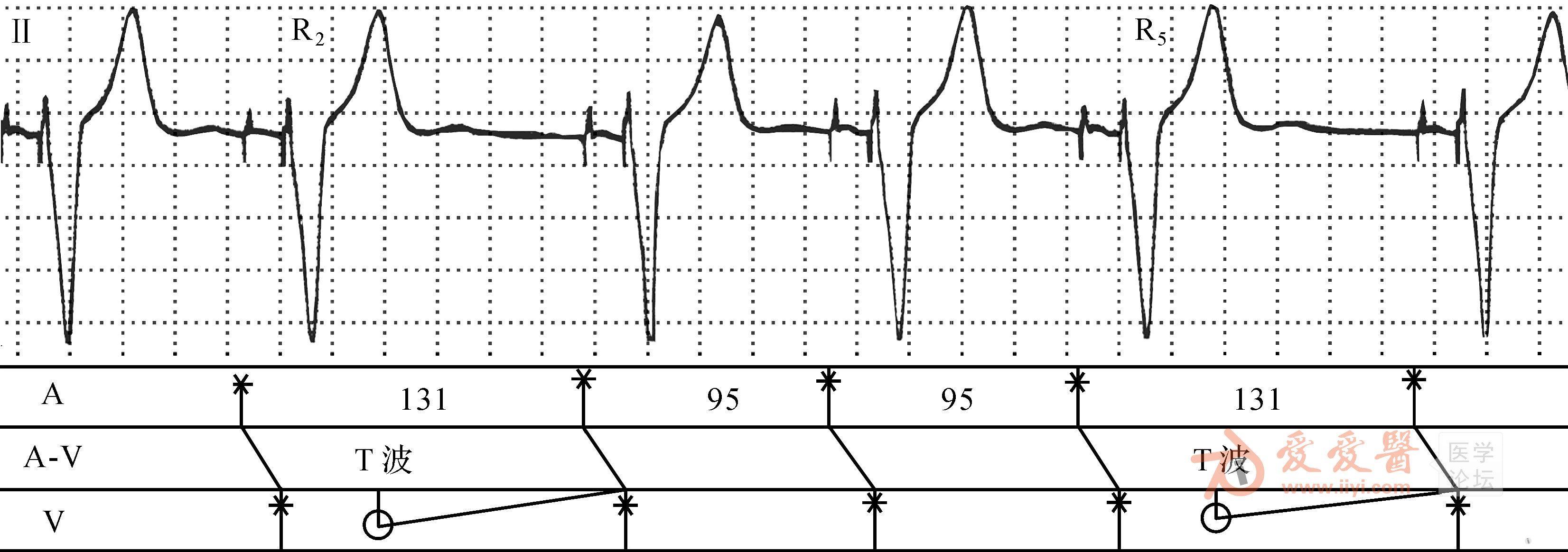 双腔起搏器心电图图片
