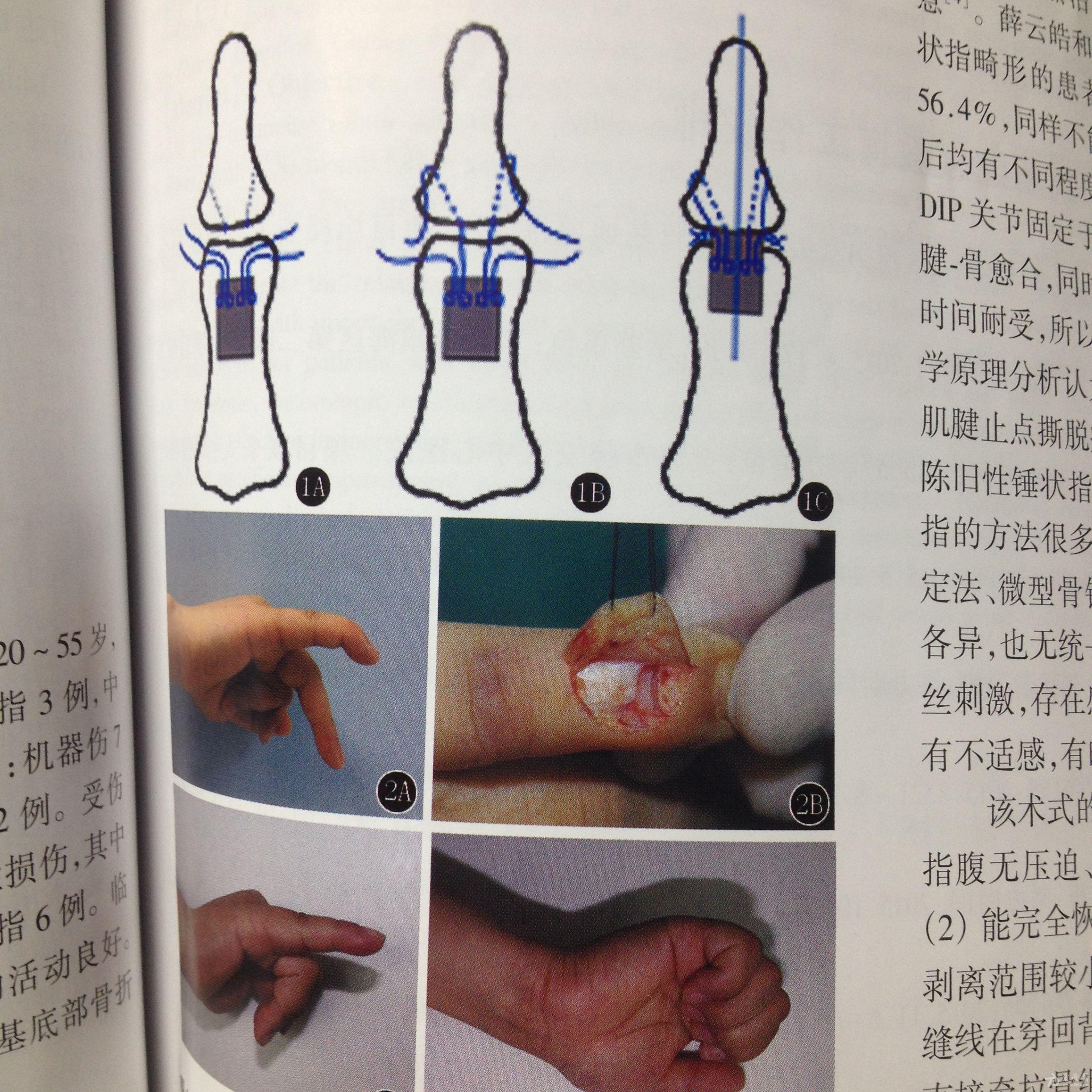 垂状指,用2孔钢板固定骨折
