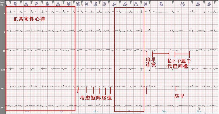 请教快的是心律不齐还是短阵房速