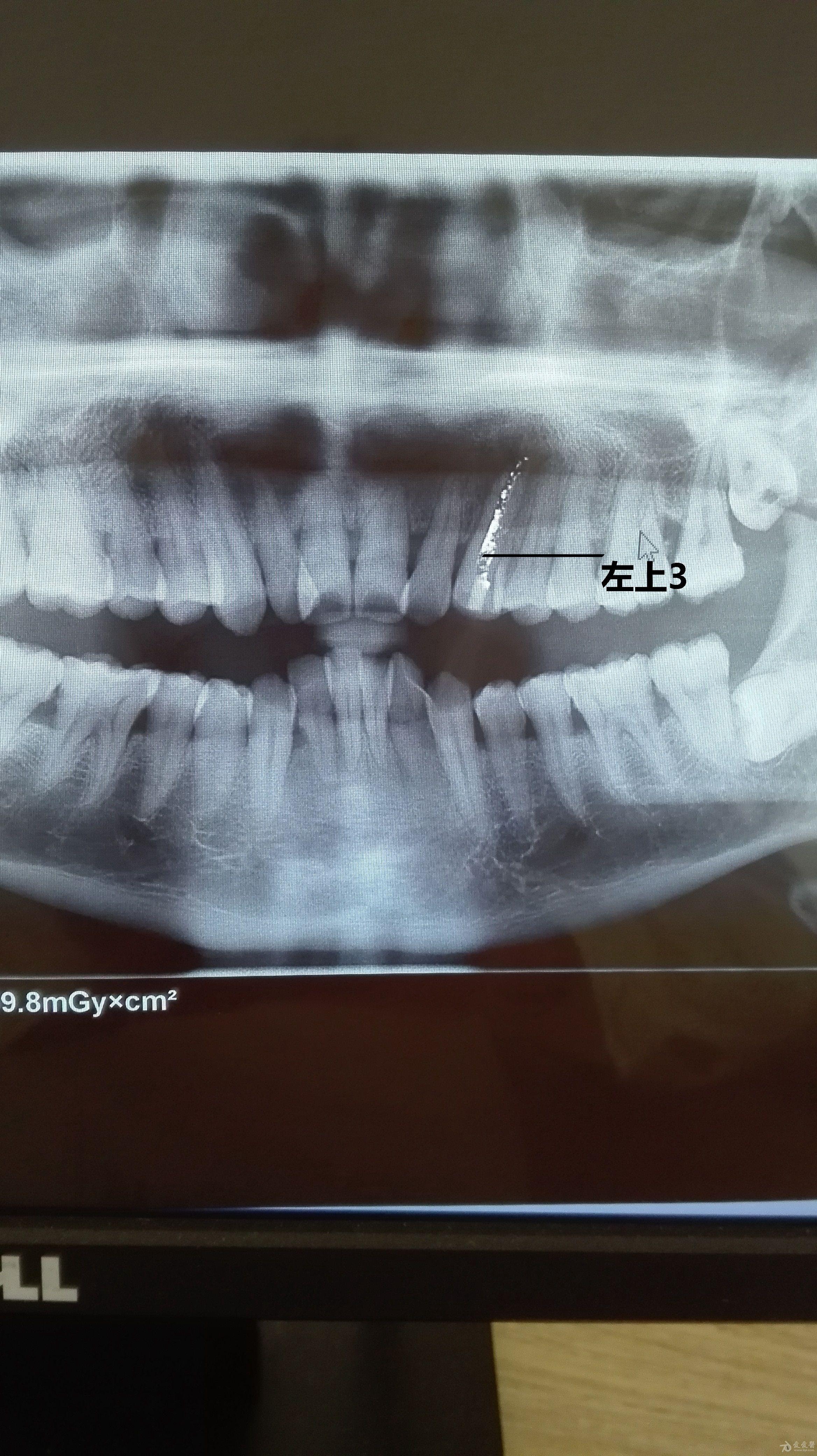 牙齿根尖周炎x光图片图片