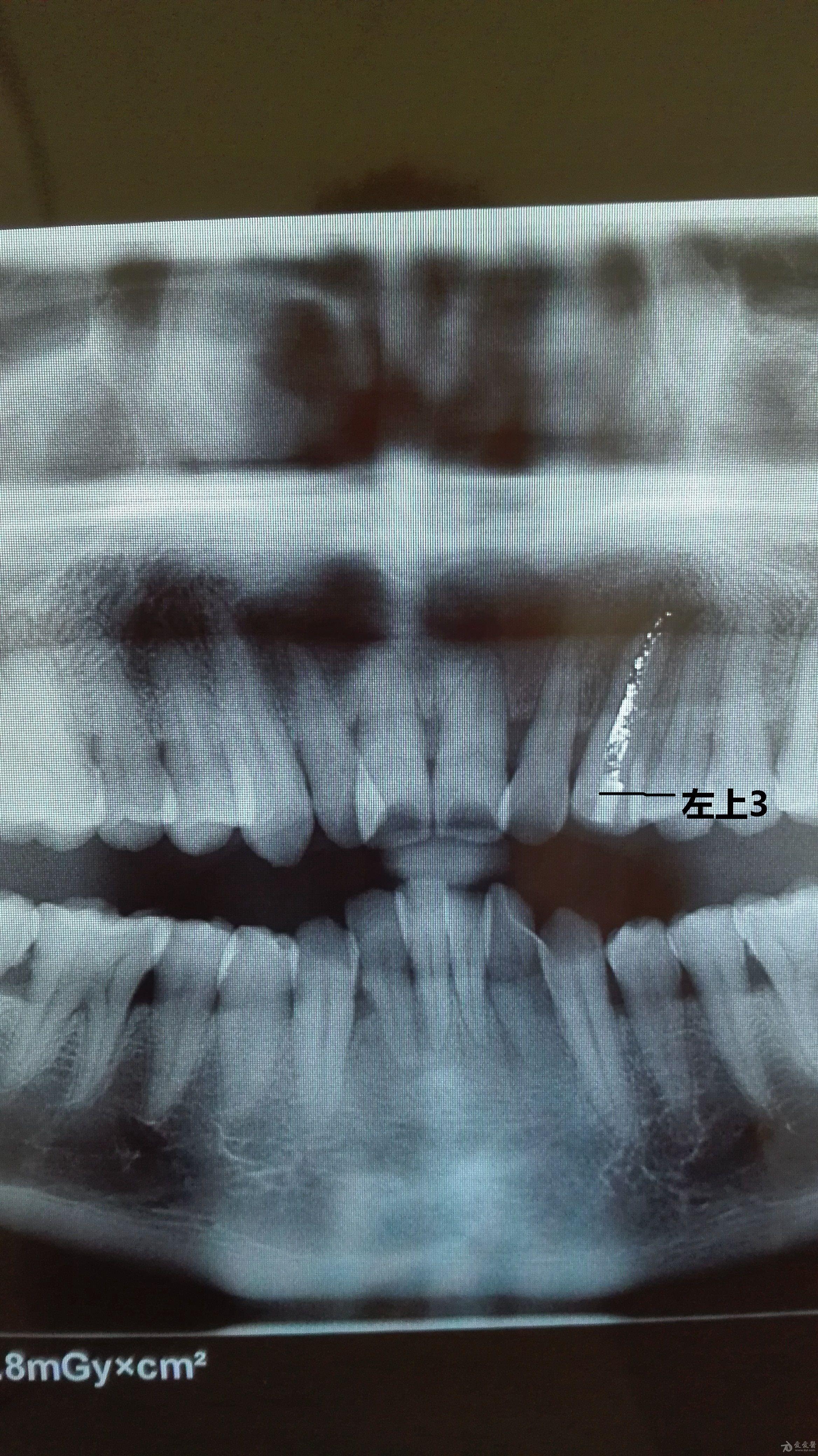 口腔图片有奖征集活动左上3慢性根尖周炎原创