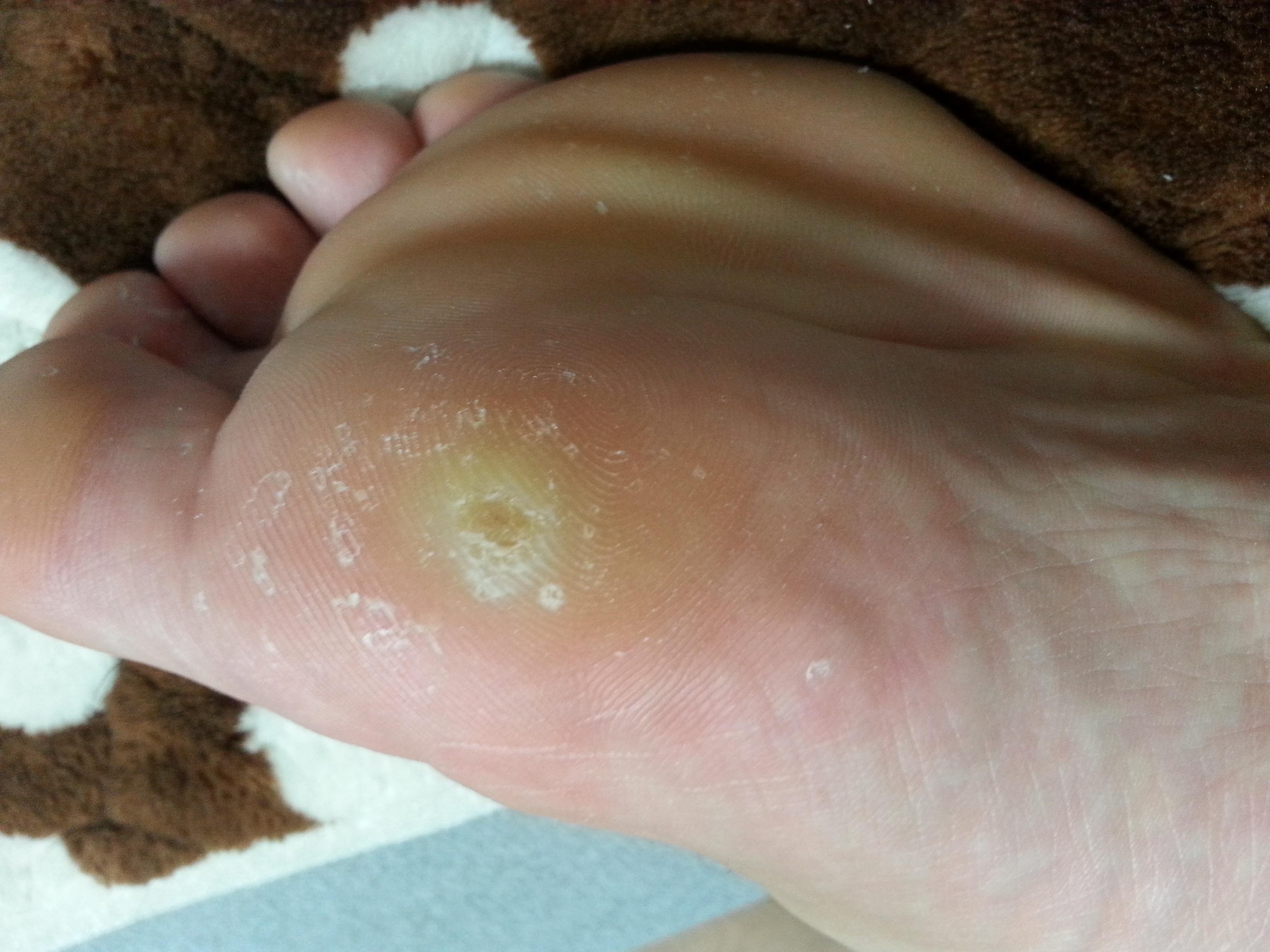 帮忙看下这是什么疣