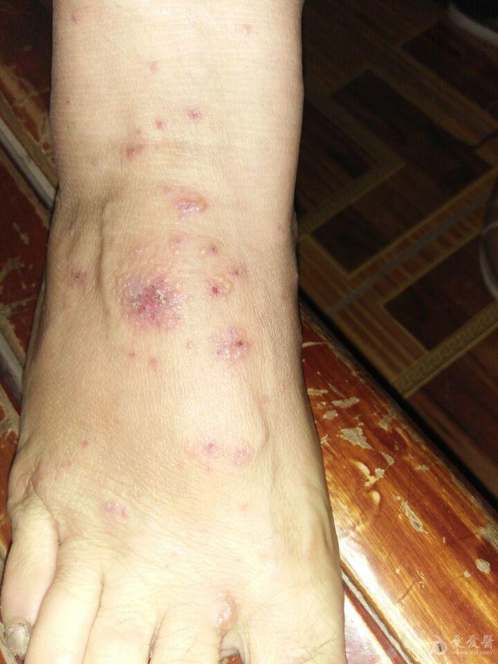 全身皮肤瘙痒十多天晚上尤甚