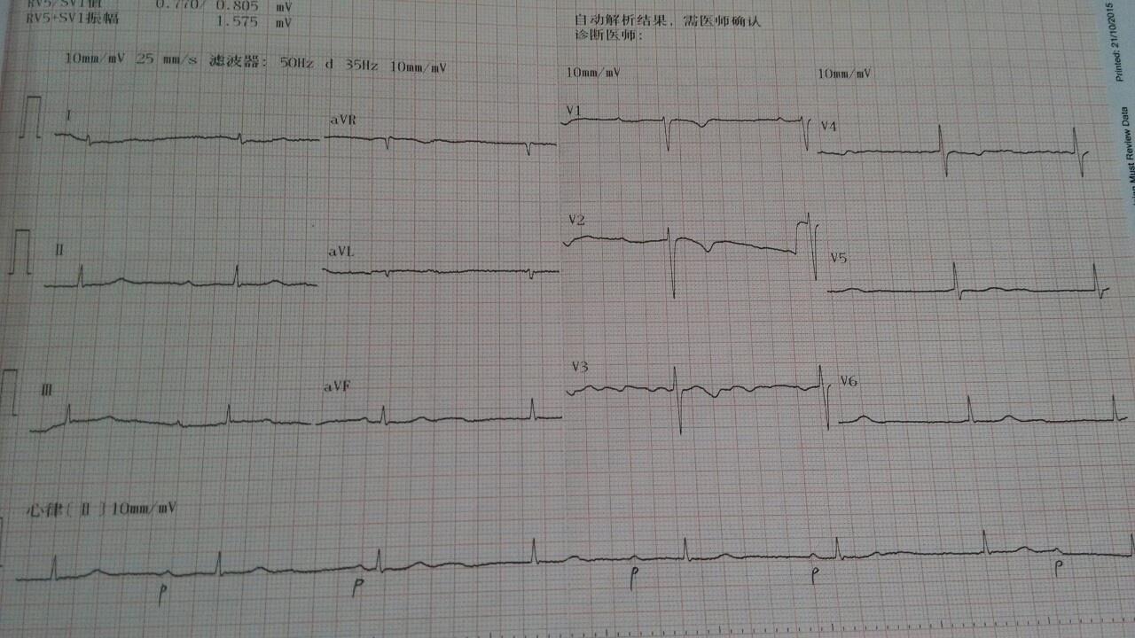 请大家帮忙看看 怎么下诊断才好 心电图脑电图专业讨论版 爱爱医医学论坛
