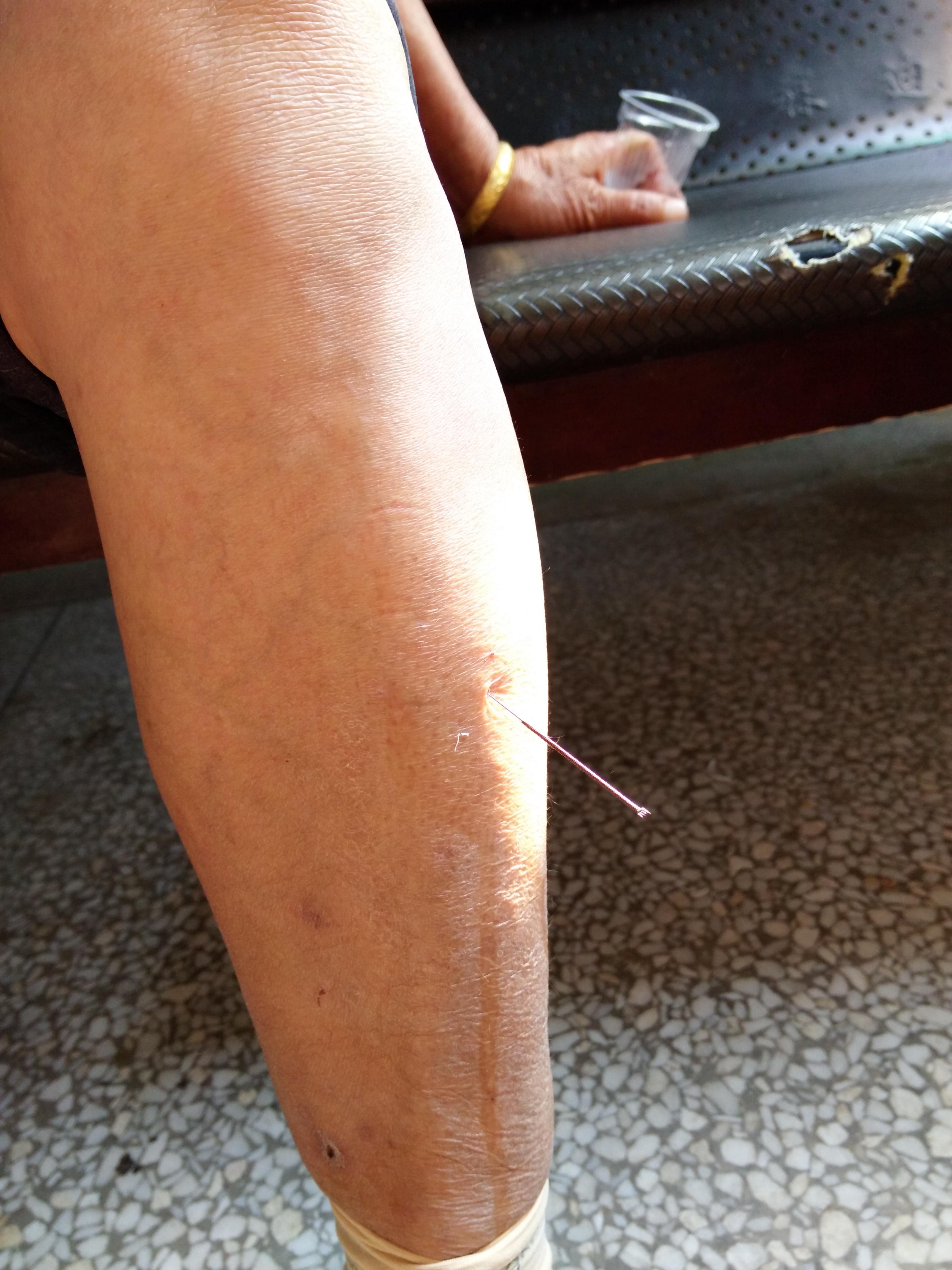 颈肩肘腕痛综合病例