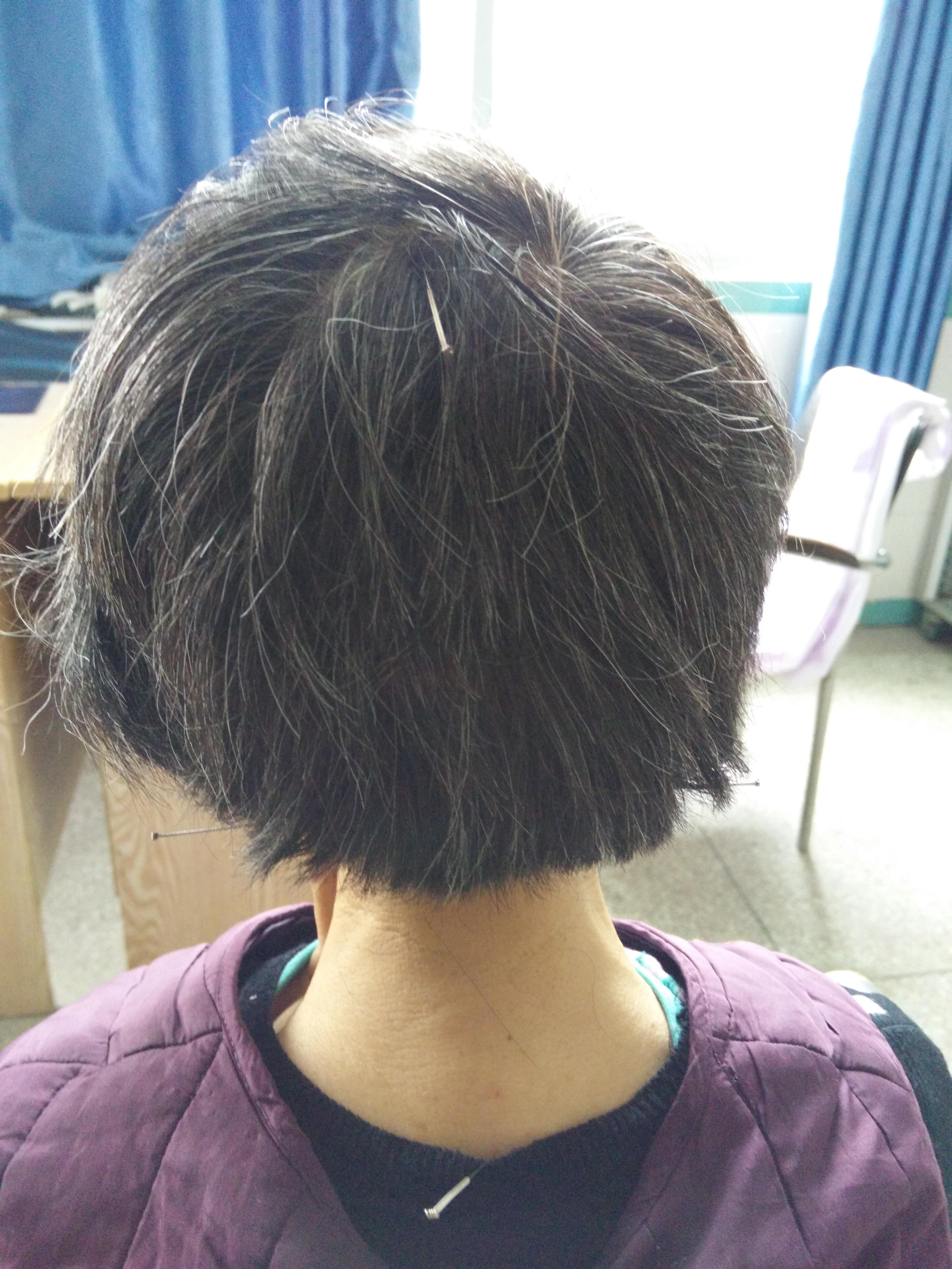 椎动脉型颈椎病针灸治疗一例