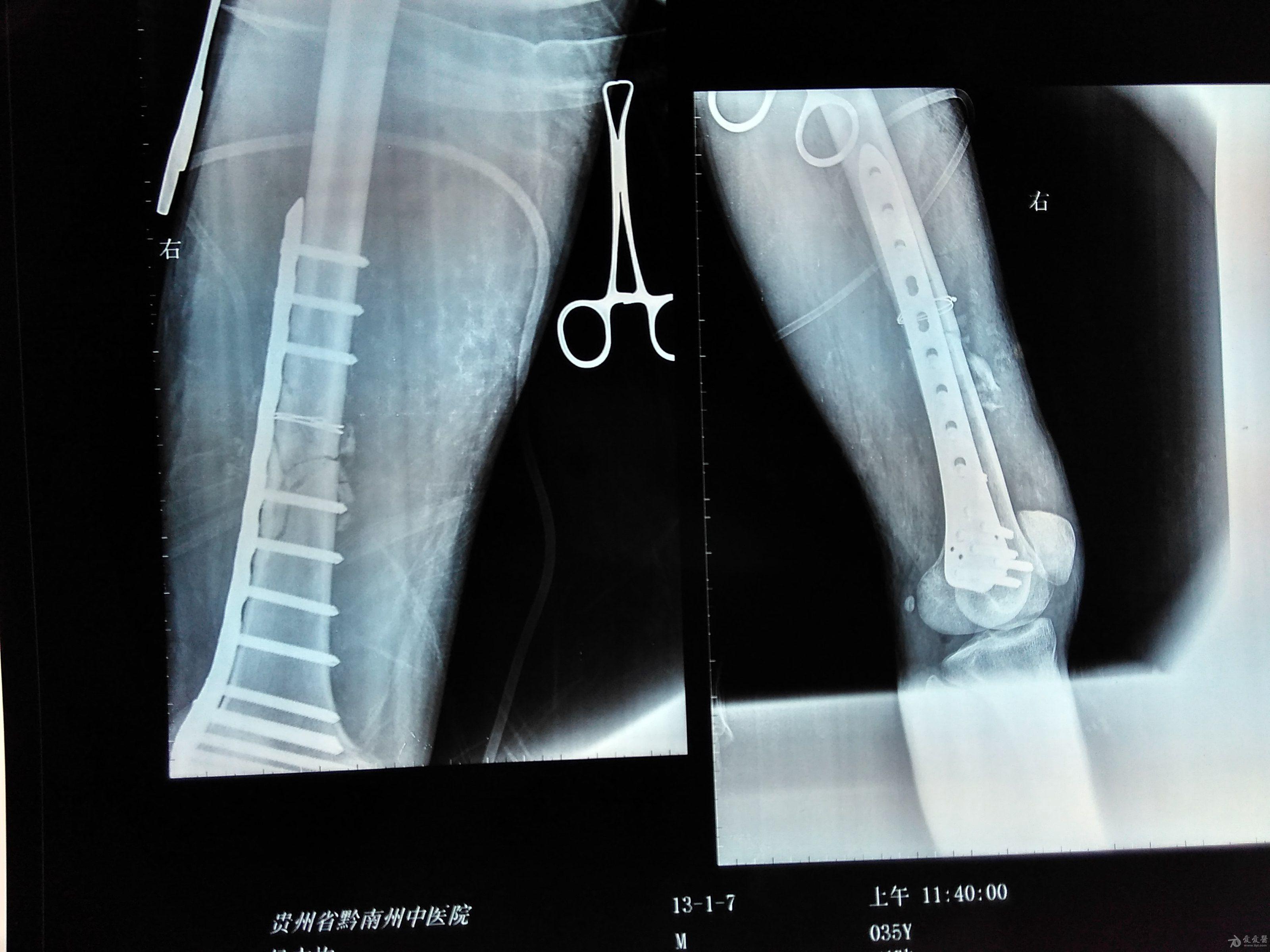 一例股骨干骨折钢板取出术后再次骨折的病例,请各位