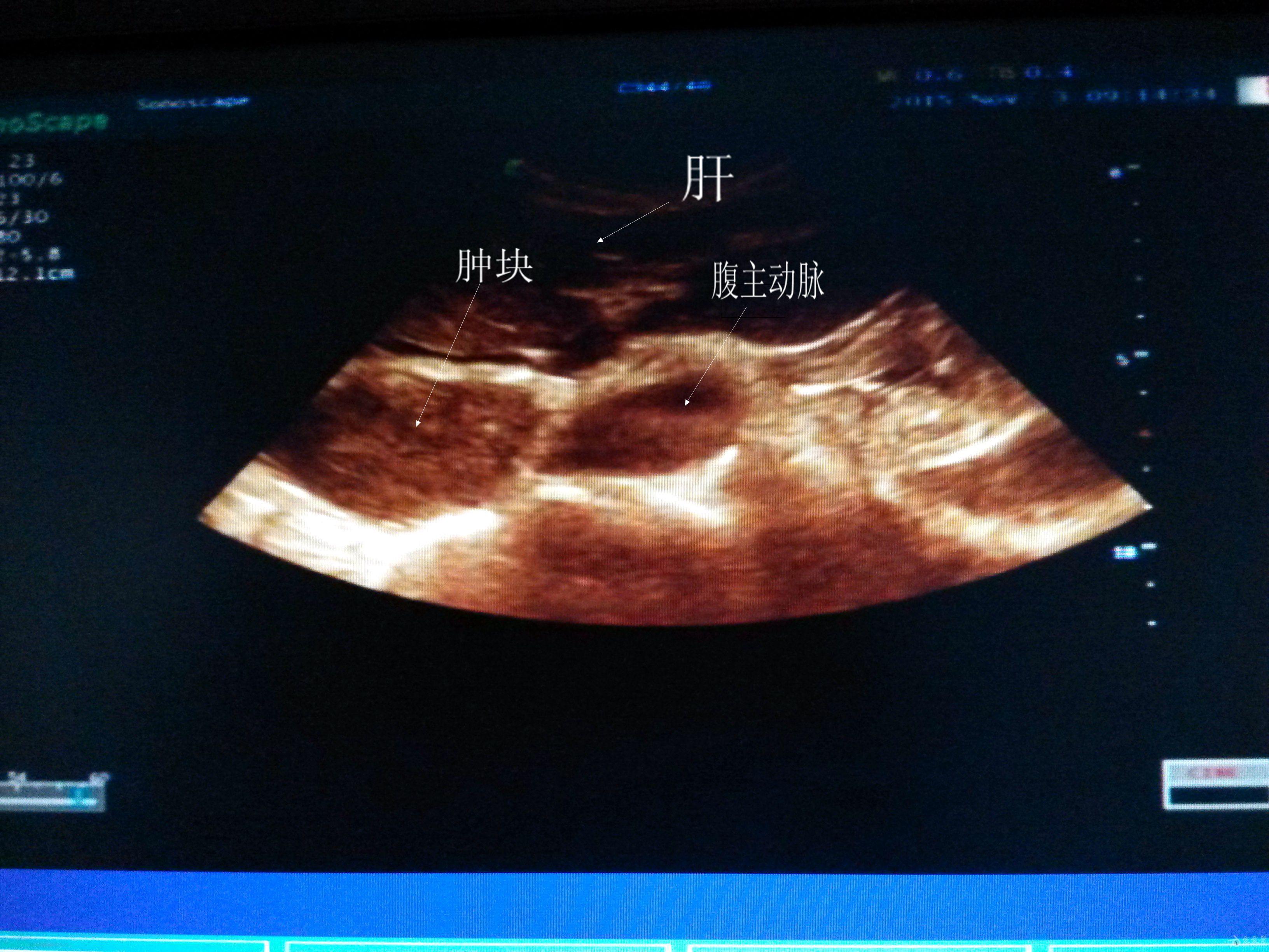 上腹部肿块是什么