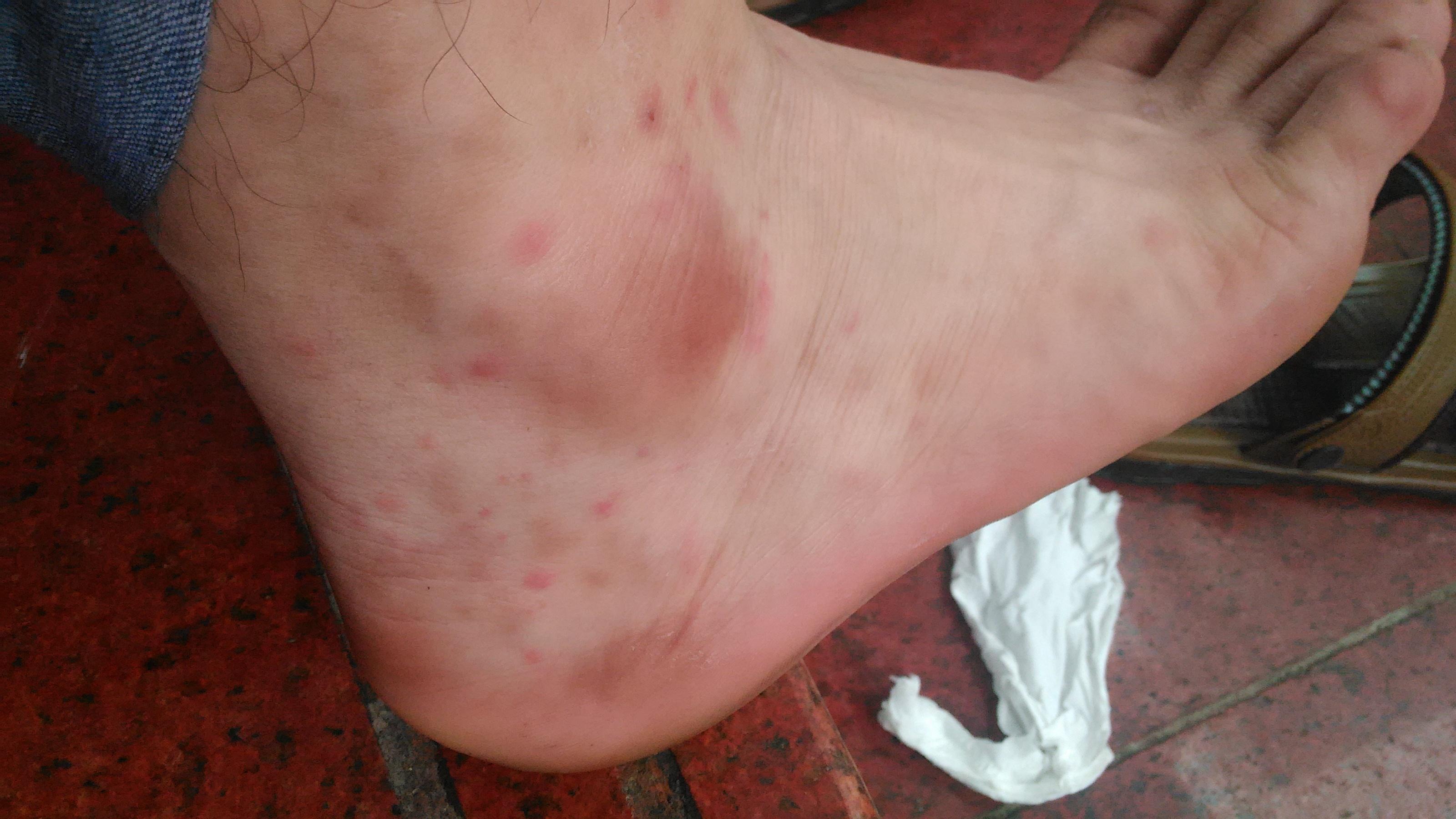 过敏性紫癜怎么办