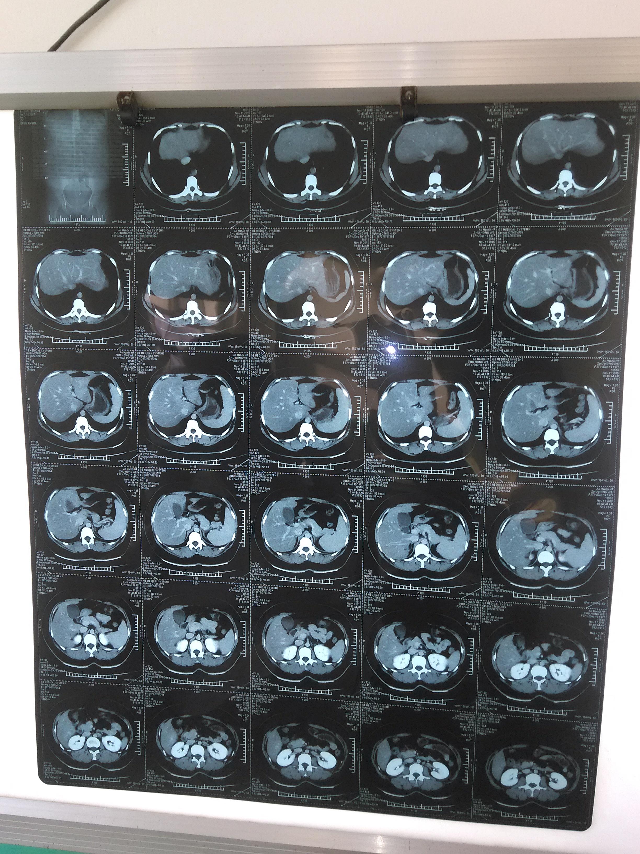 请老师们看看这个加强ct