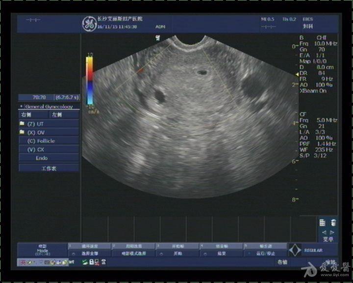 宫角妊娠图片彩超图片